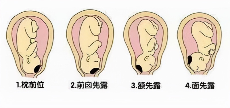 头先露可以顺产吗,头先露和枕先露各有几种胎位