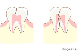 牙齿表面有裂纹是否伤到牙根,一般哪些部位的牙齿容易牙隐裂