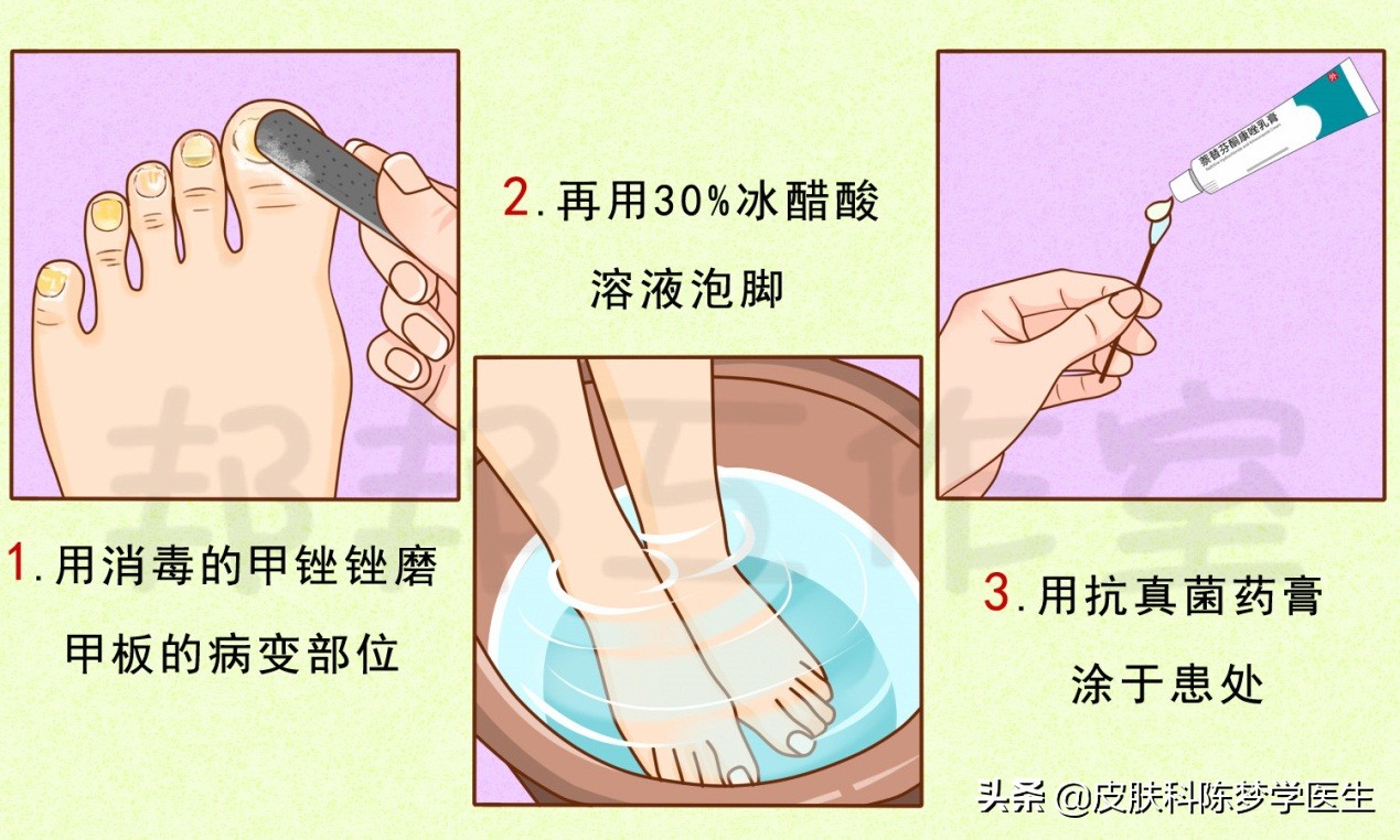 灰指甲用什么外用药好,灰指甲可以用的中医药膏