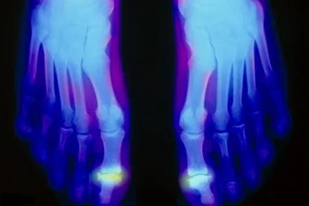 老年人风湿性关节炎用什么方法治,如何缓解风湿关节炎疼痛