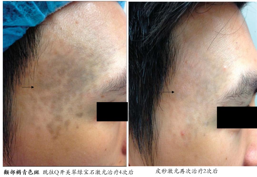 皮秒激光伤皮肤吗,皮秒激光能治凹陷疤痕吗