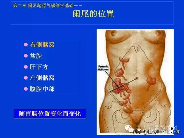 阑尾炎课件,阑尾炎的超声课件