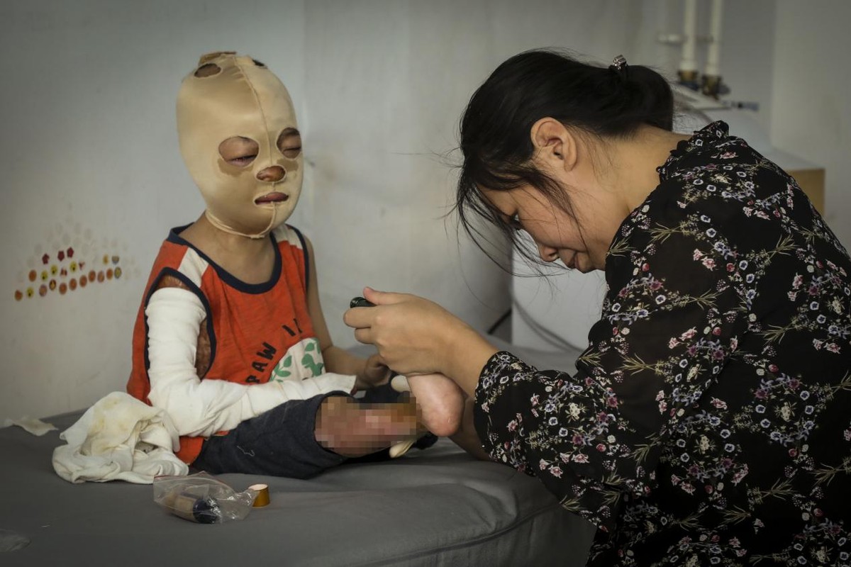 孩子被开水烫伤母亲却只心疼杯子,小孩掉进开水盆80%烫伤