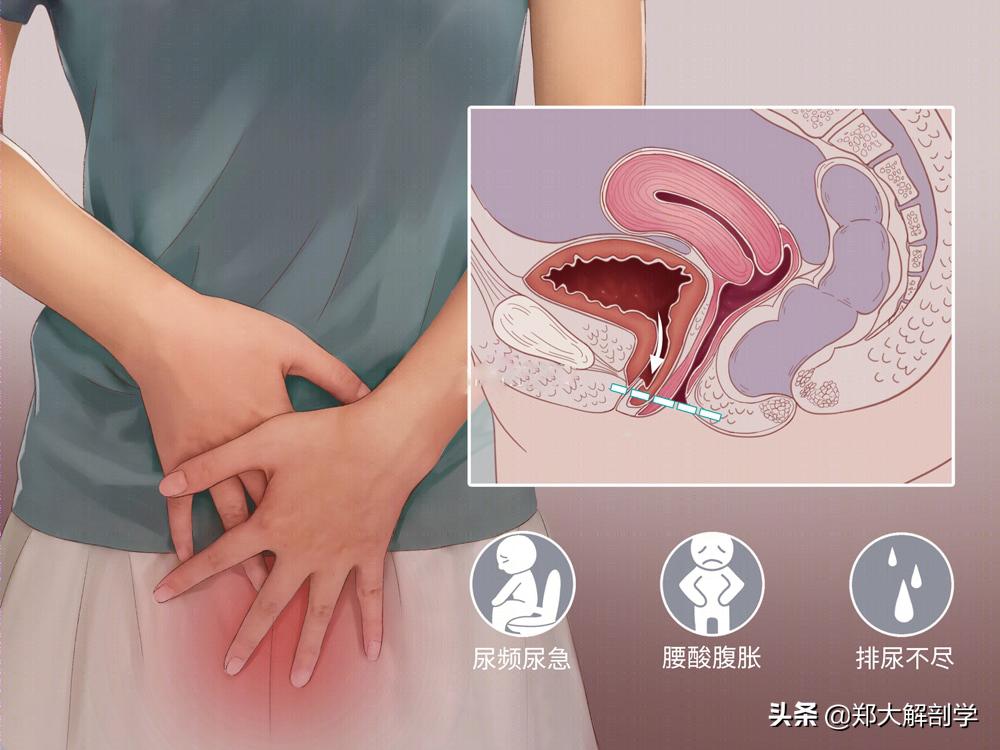 女性盆底功能障碍性疾病表现,盆底功能障碍会引起失眠吗