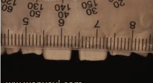 门牙缝可以补吗,为什么门牙有缝