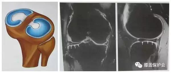 半月板最怕的动作别再做了,半月板损伤错误治疗