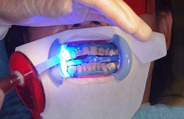 揭露欧美明星牙齿美白的秘密,牙齿美白最好的方法大黄牙