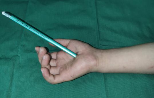 告诉孩子铅笔戳人的危害,孩子手被铅笔戳到什么样子