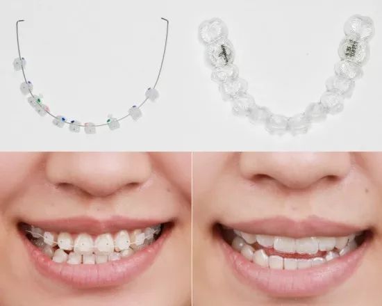 牙齿矫正全过程看完你就知道,目前几种常见的牙齿矫正方式