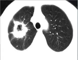 肺部ct十大征象,肺部ct正常图和异常图的区别