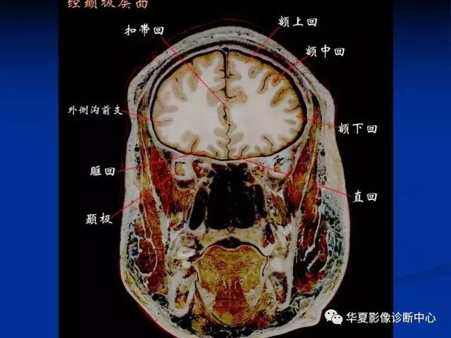 电子版头颅ct与mri断层解剖,头颅mri血管解剖与分段详解