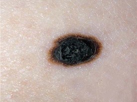 色素痣怎样去除,色素痣怎么去除最快最有效