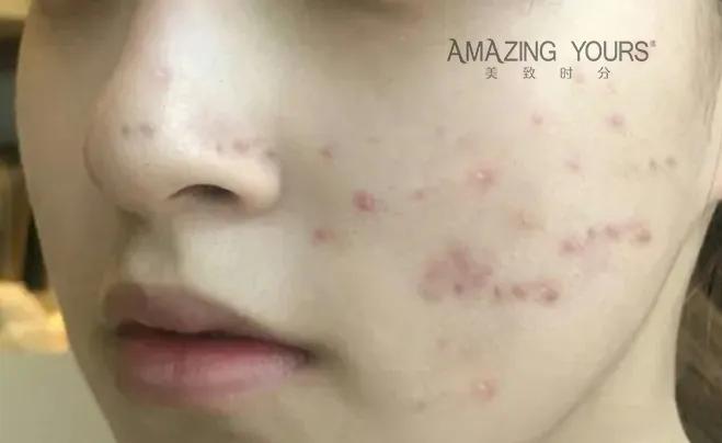 如何去除痘印留下的黑色素,如何去除背上的痘痘和痘印