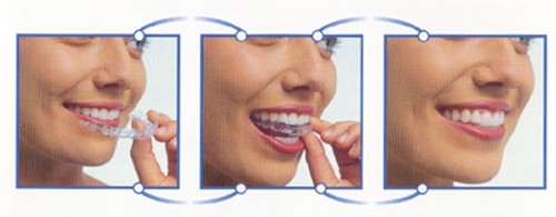 矫正牙齿你最关心的问题,矫正前需要问医生的问题