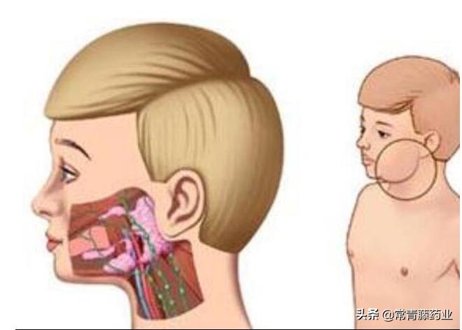 如何判断腮腺炎引起的不育症,脸肿成猪头了怎么办