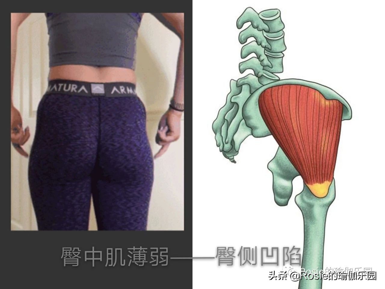 你以为你是翘臀其实是骨盆前倾,你以为的翘臀有可能是骨盆前倾