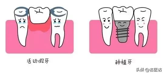 种植牙丨缺牙、补牙，你掉进这5大坑了吗？