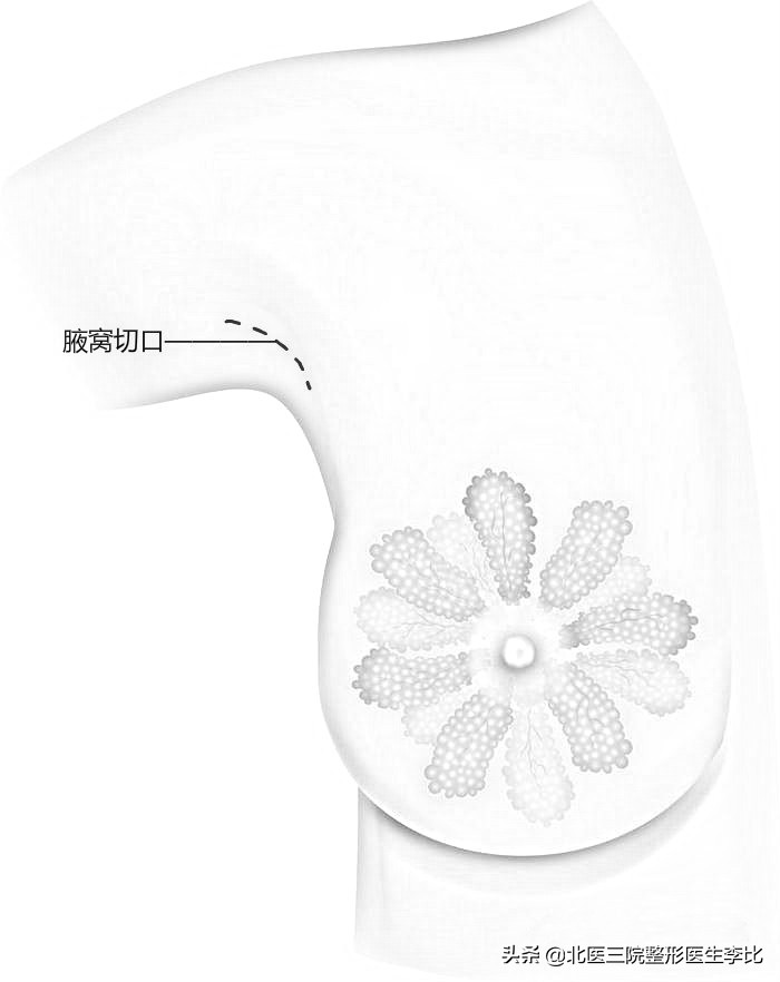 假体隆胸各种切口的优缺点,假体隆胸哪个切口最合适