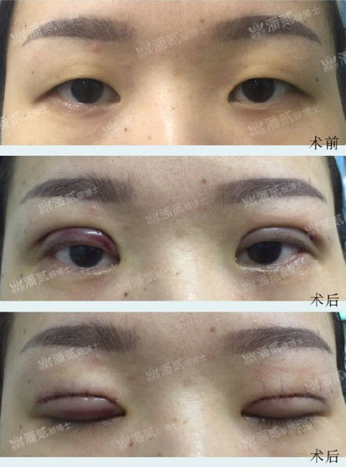 全切双眼皮提肌失败还能修复吗,什么是失败的双眼皮