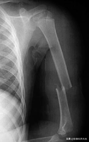 骨折的影像学检查及各自的优势,骨折的影像学愈合标准