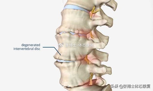 运动腰肌损伤怎么恢复,运动康复腰椎失稳