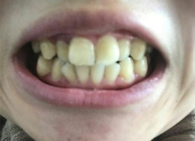 洗完牙还是黄牙怎么变白牙,牙黄怎么刷牙都不掉怎么办