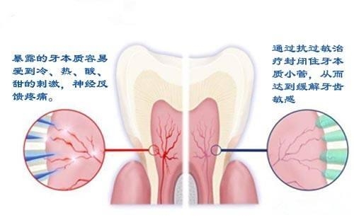 口腔科医生：什么是牙髓炎？牙髓炎主要有哪些症状？