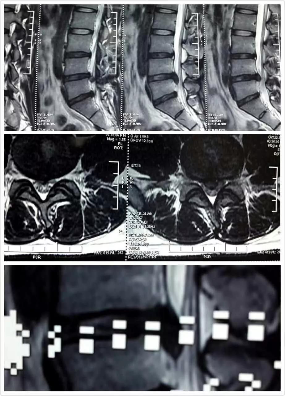 腰痛要警惕四种原因腰椎肿瘤,腰痛引起腰椎滑脱怎么治