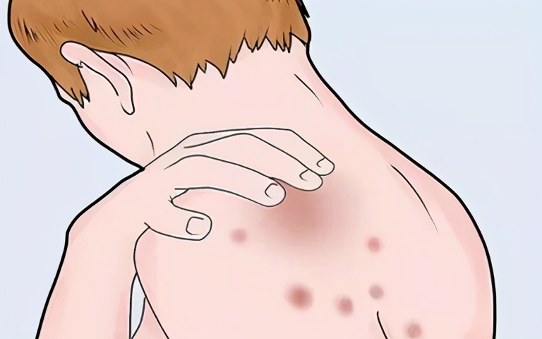 宫颈癌放疗出现副作用怎么办,宫颈癌放疗的副作用怎么消除