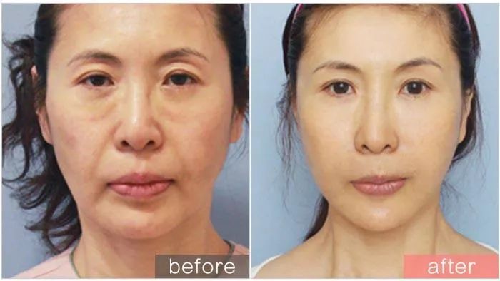 超声波裁刀维修处理过程,超声刀图解100例