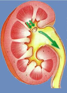 泌尿系统结石是什么,泌尿系统的结石有哪些