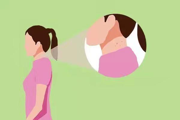 小揪揪是丝状疣吗,脖子上的小揪揪是什么