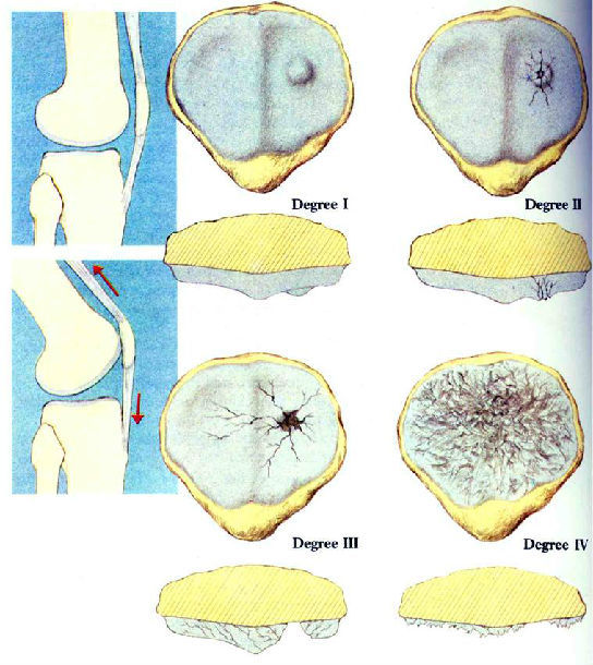 髌骨软化是看中医还是西医,骨科髌骨软化治疗