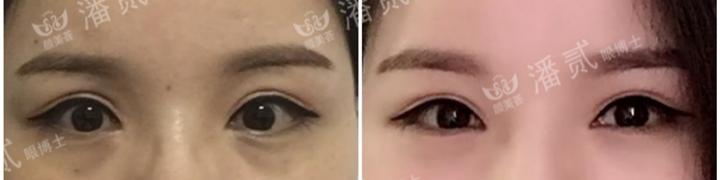 双眼皮手术后眼神凶狠是什么原因,双眼皮手术后显凶