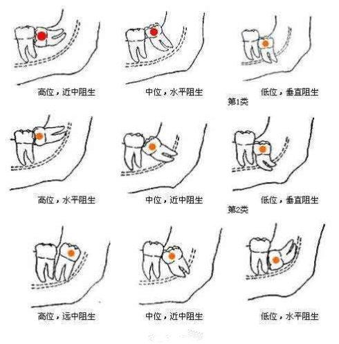 智齿未完全萌出要不要拔除,智齿有必要拔吗图片大全