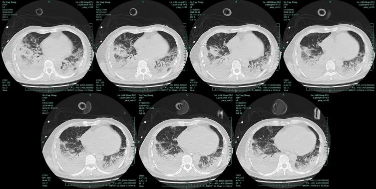 mngs病原检测的优势,mngs真的可靠吗