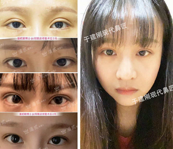 双眼皮术后恢复不一致正常吗,双眼皮术后看着不对称