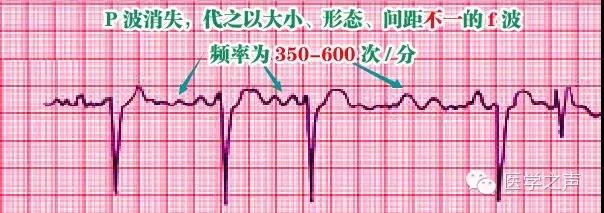 如何简单有效的预防中风,中风风险高怎么办
