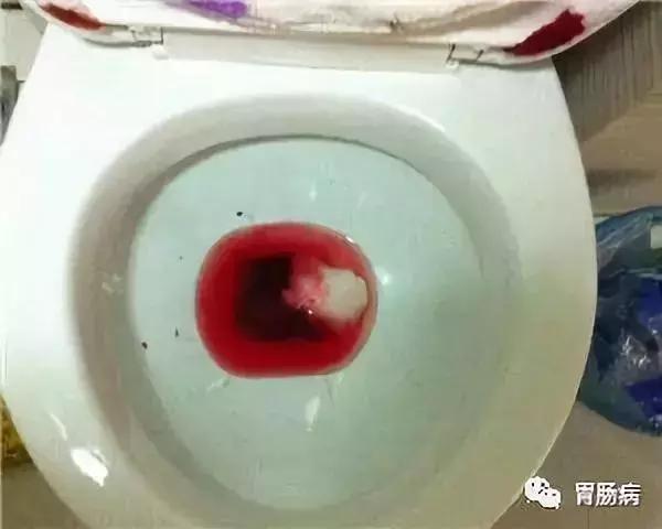 直肠癌内痔可以误诊吗,直肠癌误诊为痔疮的原因是什么