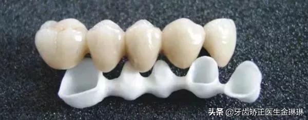 全瓷牙和烤瓷牙哪个更结实,钴铬合金烤瓷牙和全瓷牙优缺点