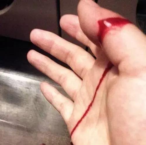 经常被烫伤割伤是犯了什么,烫烧伤怎么处理好得快