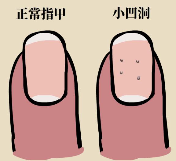 指甲上有凹痕是什么原因,指甲出现甲凹点是什么原因