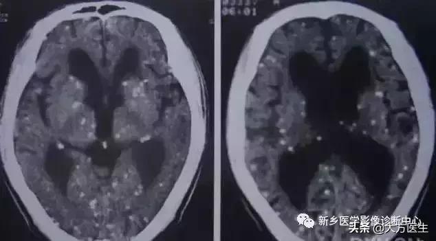 钙化灶是良性肿瘤的可能性大吗,颅内肿瘤钙化发生率最高