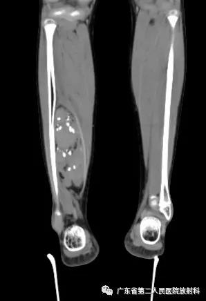 这个病例让我大涨知识：14岁男性右小腿痛性包块