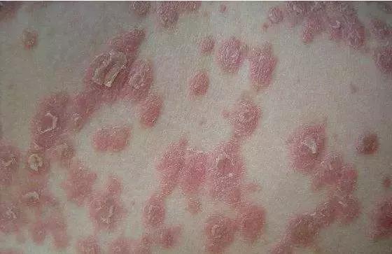 被屠呦呦团队盯上的红斑狼疮到底是什么病？致死但5年生存率达90%