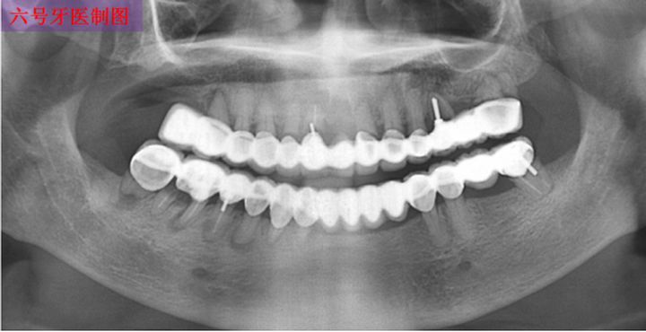 18岁女孩牙齿磨了,门牙是烤瓷牙可以矫正牙齿吗