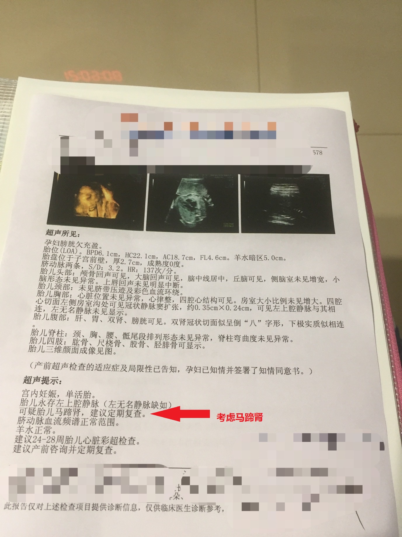 常见的先天性肾脏畸形,先天性肾发育不良肾是什么样的