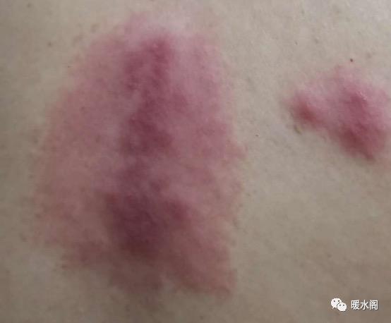 皮肤疱疹神经痛,皮肤烧灼感带状疱疹