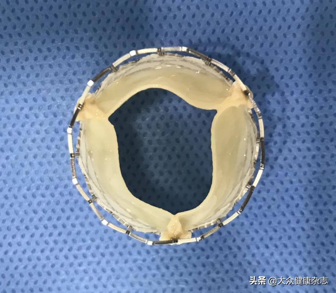 球囊扩张主动脉瓣膜,心脏球囊扩张瓣膜