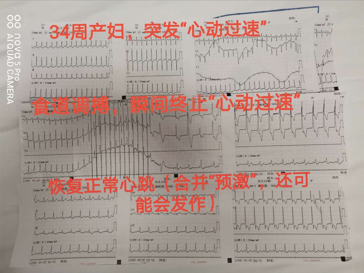 孕妇心动过速外加有点心肌缺血,怀孕心电图窦性心动过速心慌胸闷
